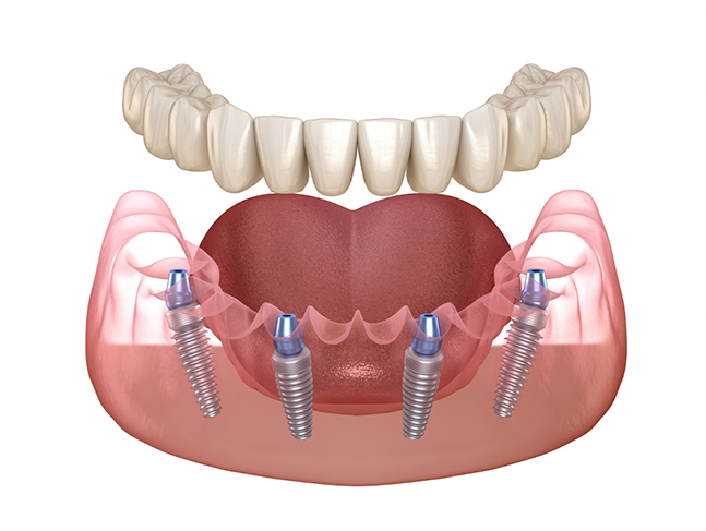 Illustration of an All-on-4 implant denture