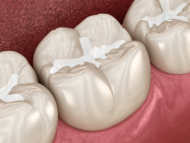 Illustration of a row of teeth with dental sealants