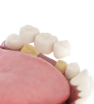 Model of a dental bridge supported by two natural teeth