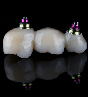 Dental bridge with implant attachments