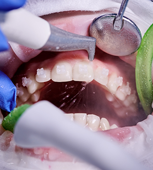 Close up of a dental patient's teeth being cleaned