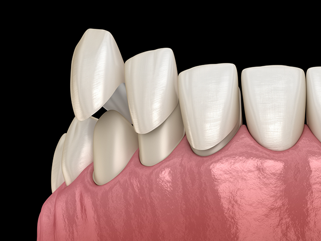 Illustration of veneers being placed over the fronts of teeth