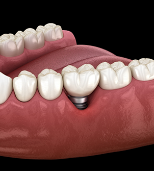 Illustrated dental implant with a crown replacing one missing tooth