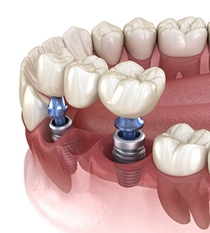 Illustration of two dental implants supporting a dental bridge