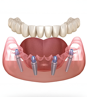 Illustration of four dental implants throughout the jaw supporting a full denture