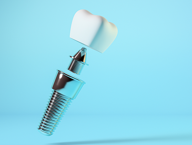 Illustration of a dental implant post, abutment, and crown