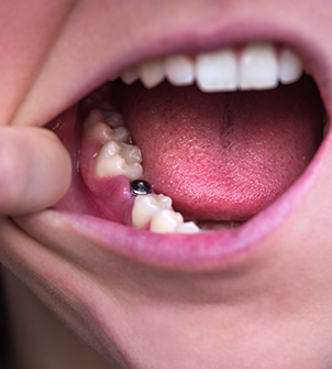 Close up of a mouth with a visible dental implant abutment