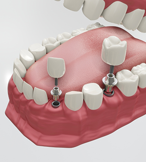 Illustration of two dental implants with crowns replacing two teeth