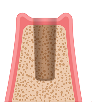 Illustration of an empty section of jawbone where a tooth is missing