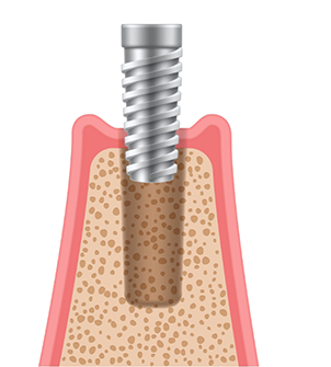 Illustration of a dental implant post being placed in the jawbone