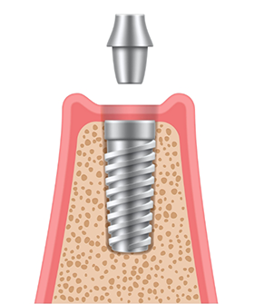 Illustration of an abutment being placed atop a dental implant post in the jaw