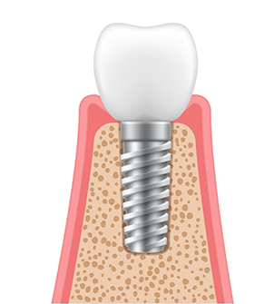 Illustration of a dental crown atop an abutment