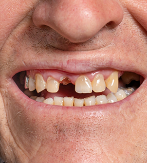 Close up of a man smiling with multiple missing teeth