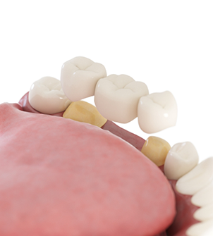 Illustration of a dental bridge replacing a missing tooth