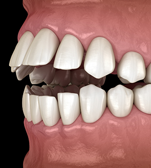 Illustrated mouth with an open bite