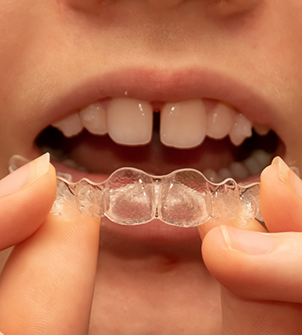 Close up of a teen placing Invisalign over their teeth