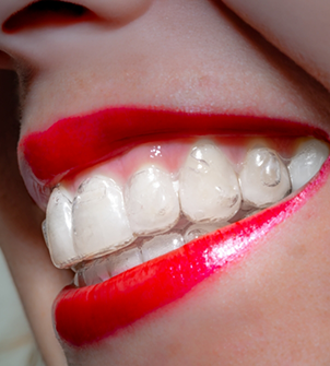 Close up of a woman smiling with Invisalign over her teeth
