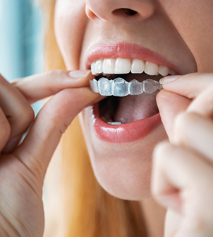 Blonde woman placing Invisalign over her teeth