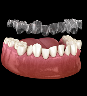 Illustration of Invisalign being placed over crowded teeth