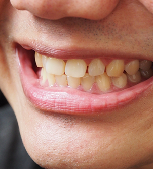 Smile with small gaps between the teeth