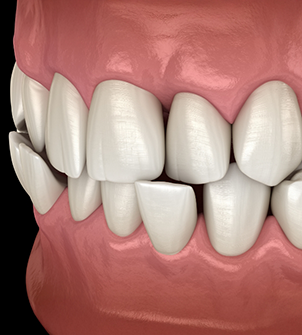 Illustrated mouth with a crossbite