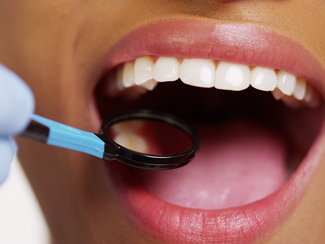 Close up of a dental mirror inside of a mouth