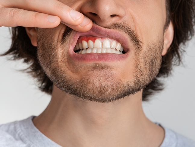 Man pointing to his red gums