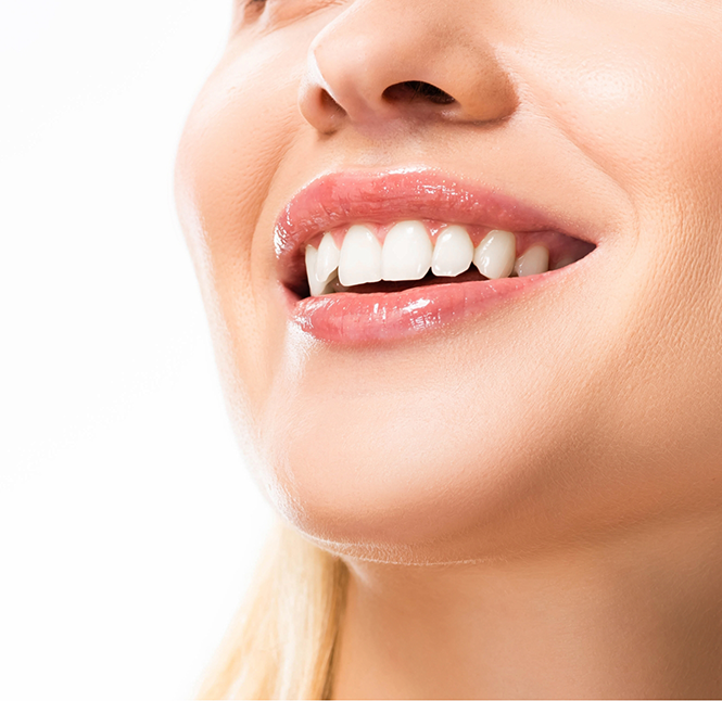Close up of a flawless smile with veneers in San Antonio