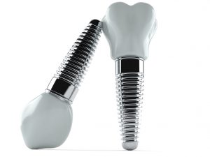 If you’re looking for the gold standard of artificial teeth, a dental implant in San Antonio can last almost forever with proper care.